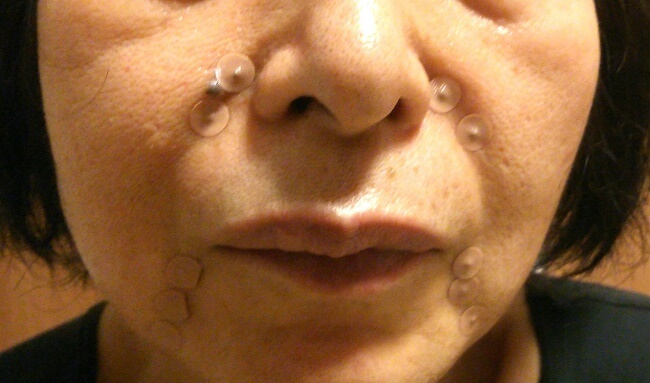 60代のほうれい線にアキュライフ